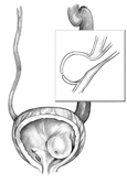 Front-view drawing of a bladder and ureter showing ureterocele. The ureter is swollen. The bladder is shown in cross-section to reveal that the ureter extends into the interior of the bladder. An inset shows a side-view cross section of the ureter.