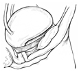 Diagram of side view of female bladder supported by a sling to prevent urinary incontinence. The sling is wrapped around the urethra, and the ends are attached to the pubic bone.