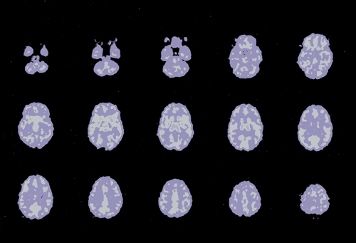 Effects of Ecstasy Addiction shown on Brain Scan