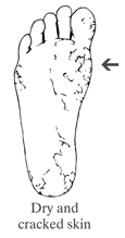 Drawing of a foot showing dry and cracked skin.