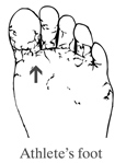 Drawing of a foot showing athlete's foot.
