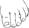 Drawing of a foot with a corn and a callus.