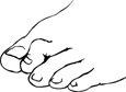 Drawing of a foot with a hammertoe.