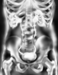 Drawing of an intravenous pyelogram, which is an x ray of the urinary tract.