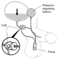 Drawing of an artificial sphincter to treat male urinary incontinence. Labels point to a pump in the scrotum, a cuff around the urethra, and a pressure-regulating balloon inside the bladder. An inset shows a close-up of the cuff around the urethra.