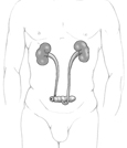 Drawing of an ileal conduit urinary diversion. The urinary diversion is shown within the outline of a male figure. The kidneys, ureters, and conduit made from a section of intestine are visible.