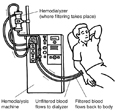 Drawing of a patient receiving hemodialysis treatment. Labels point to the hemodialyzer, where filtering takes place; hemodialysis machine; a tube where unfiltered blood flows to the dialyzer; and a tube where filtered blood flows back to the patient's body.