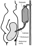 Diagram of a patient receiving continuous ambulatory peritoneal dialysis. Labels point to the dialysis fluid, catheter, peritoneum, and abdominal cavity.