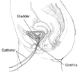 Drawing of the female urinary tract. Labels point to two catheters, the urethra, and the bladder.