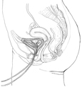 Drawing of the female urinary tract. Two catheters are placed in the urethra and bladder.