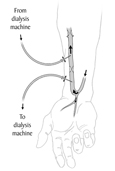 Drawing of a forearm with an arteriovenous fistula. Arrows show the direction of blood flow. Two needles are inserted into the fistula. Labels explain that one needle carries blood to the dialysis machine. The other returns blood from the machine.