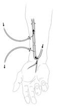 Drawing of a forearm with an arteriovenous fistula. Arrows show the direction of blood flow. Two needles are inserted into the fistula.
