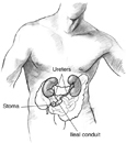 Drawing of an ileal conduit urostomy. Labels point to the stoma, ileal conduit, and ureters.