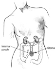 Drawing of a continent cutaneous reservoir. Labels point to the internal pouch and stoma.