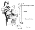 Drawing of a male patient during peritoneal dialysis exchange.