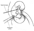 Drawing of a kidney in cross-section to show an internal stone. A thin wire labeled 