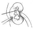 Drawing of a kidney in cross-section to show an internal stone. A thin wire is inserted through the skin into the kidney to locate the stone. A slightly thicker probe is also inserted through the skin into the kidney to deliver sound waves that will break up the kidney stone.