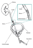 Drawing of a bladder, ureter, and kidney. The bladder and ureter are shown in cross-section to reveal a long scope, labeled