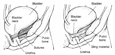 Two diagrams of bladder held in place after surgery. On the left, the bladder is held in place by sutures. Labels point to the bladder, bladder neck, pubic bone, sutures, and urethra. On the right, the bladder is held in place by a sling. Labels point to the bladder, bladder neck, pubic bone, sling material, and urethra.