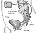 Diagrama de un disposotivo de estimulacion electrica implantado en el abdomen de una mujer. Se etiqueta al estimulador electrico, la vejiga, el coccix y los nervios.