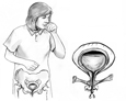 Ilustracion de una mujer tosiendo con el hueso pelvico y la vejiga expuesta. Una recuadro ensena una vejiga con una pelvis debil que permite que la orina se escape.