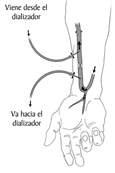 Una ilustracion de un antebrazo con una fistula arteriovenosa. Las flechas muestran la direccion del flujo de sangre. Dos agujas se insertan en la fistula. Las etiquetas explican que una aguja lleva la sangre hacia la maquina del dializador. La otra regresa la sangre desde la maquina del dializador.
