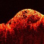 Optical Coherence Tomography (OCT) image of a sarcoma