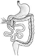 Drawing of malrotation of the bowel in which the cecum is not positioned correctly.