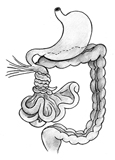 Drawing of volvulus in which a portion of the intestine twists around itself.