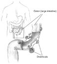 Drawing of the colon and an enlargement of it showing diverticula with colon (large intestine) and diverticula labeled.