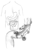 Drawing of colon and an enlargement of it showing diverticula.