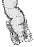 Drawing of cross section of the rectum and anus.