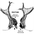 Drawing of the rectum with an internal hemorrhoid and an external hemorrhoid labeled.