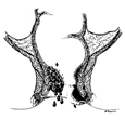 Drawing of the rectum with an internal and an external hemorrhoid.