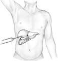 Drawing of a liver biopsy procedure.