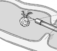 Drawing of a polyp being removed by a colonoscope, with intestine folds, polyp, and colonoscope labeled.
