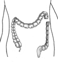 Drawing of the large intestine with diseased section detached from healthy section.