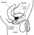 Drawing of male urinary tract showing how an enlarged prostate can squeeze the urethra and block urine flow.