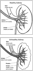 Drawings of two kidney cross sections, with the functions labeled, showing a healthy kidney and an unhealthy kidney.