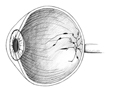 Drawing of a cross section of an eye showing some diabetic damage.
