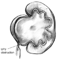 Drawing of an ureteropelvic junction (UPJ) obstruction. The point where the kidney joins the ureter is blocked. As a result, the kidney swells. The point of blockage is labeled UPJ obstruction.
