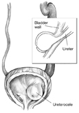 Front-view drawing of a bladder and ureter showing a ureterocele. The ureter is swollen. The bladder is shown in cross section to reveal that the ureter extends into the interior of the bladder. An inset shows a side-view cross section of the ureter.