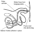 Side-view diagram of male urinary tract with Foley catheter in place to drain urine. A label points to the Foley catheter, which consists of two tubes for fluids flowing in and out of the bladder. A label explains that a balloon near the tip of the catheter holds the catheter in place. A label pointing to a tube entering the urethra at the tip of the penis explains that the tube allows water to flow into the bladder from a hanging bottle. An arrow shows the direction of the water flowing out of the catheter. A label pointing to a tube emerging out of the urethra explains that fluids drain into a sterile bag. An arrow shows the direction of flow toward the sterile bag.