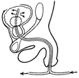 Side-view diagram of male urinary tract with Foley catheter in place to drain urine. The Foley catheter consists of two tubes for fluids flowing in and out of the bladder. A balloon near the tip of the catheter holds the catheter in place in the bladder. A tube entering the urethra at the tip of the penis allows water to flow into the bladder from the hanging bottle. An arrow shows the direction of the water flow. Arrows emerging away from the tip of the catheter in the bladder show water flowing out of the catheter. A tube emerging out of the urethra allows fluids to drain into a sterile bag. An arrow shows the direction of flow toward the sterile bag.