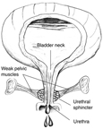 Diagram of front view of female bladder with weak pelvic muscles. The bladder is shown in cross-section to reveal urine in the bladder. The weak pelvic muscles fail to keep the urethra closed, so urine escapes.  Labels point to the bladder neck, weak pelvic muscles, urethral sphincter, and urethra.