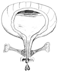 Diagram of front view of female bladder with weak pelvic muscles. The bladder is shown in cross-section to reveal urine in the bladder. The weak pelvic muscles fail to keep the urethra closed, so urine escapes.