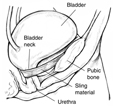 Diagram of side view of female bladder supported by a sling to prevent urinary incontinence. The sling is wrapped around the urethra, and the ends are attached to the pubic bone. Labels point to the bladder, bladder neck, pubic bone, sling material, and urethra.