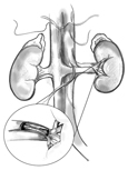 Anatomic drawing of the kidneys. An insert shows a magnified cross-section of the renal artery. Plaque is building up on the inner wall of the artery and blocking blood flow.