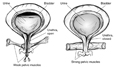Two anatomical drawings of a bladder. The bladder on the left has weak pelvic floor muscles that allow urine to escape. Labels point to bladder, urine, urethra (open), and weak pelvic muscles. The bladder on the right has strong pelvic floor muscles that keep urine from escaping. Labels point to the bladder, urine, urethra (closed), and strong pelvic muscles.