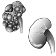Diagram of two kidneys. The healthy kidney on the lower right is smooth.